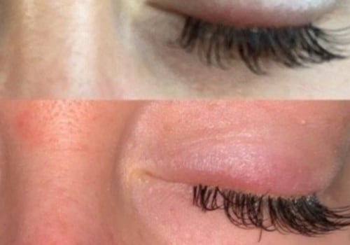 Is it normal for your eyelids to swell after eyelash extensions?
