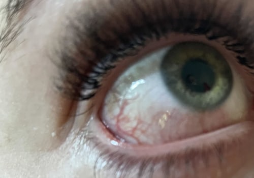 Can eyelash extension glue burn your eyes?