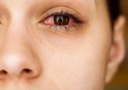 How common is allergy to eyelash extensions?